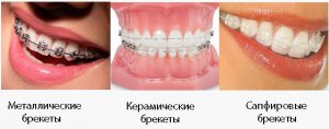 Виды брекетов
